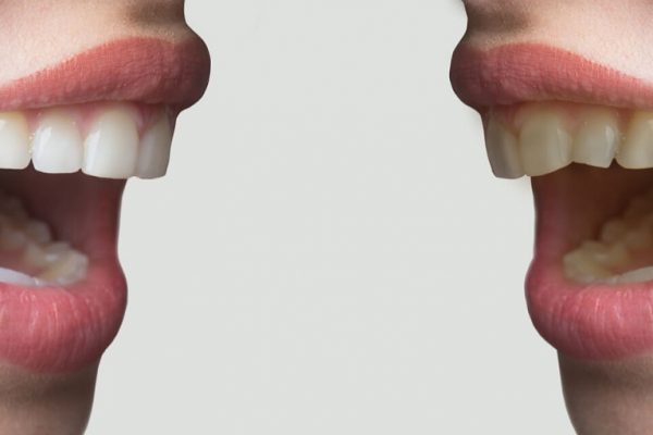 Perfect Teeth: How To Get Them