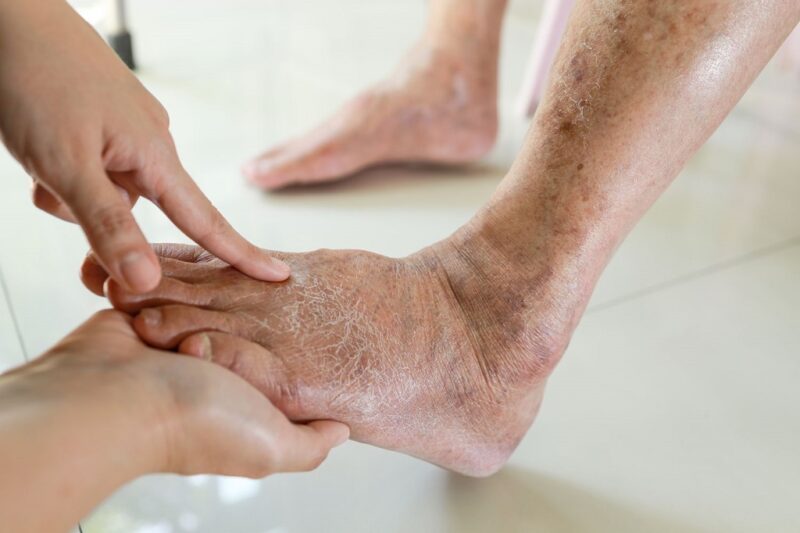 How to Safeguard Diabetic Feet? Expert Tips